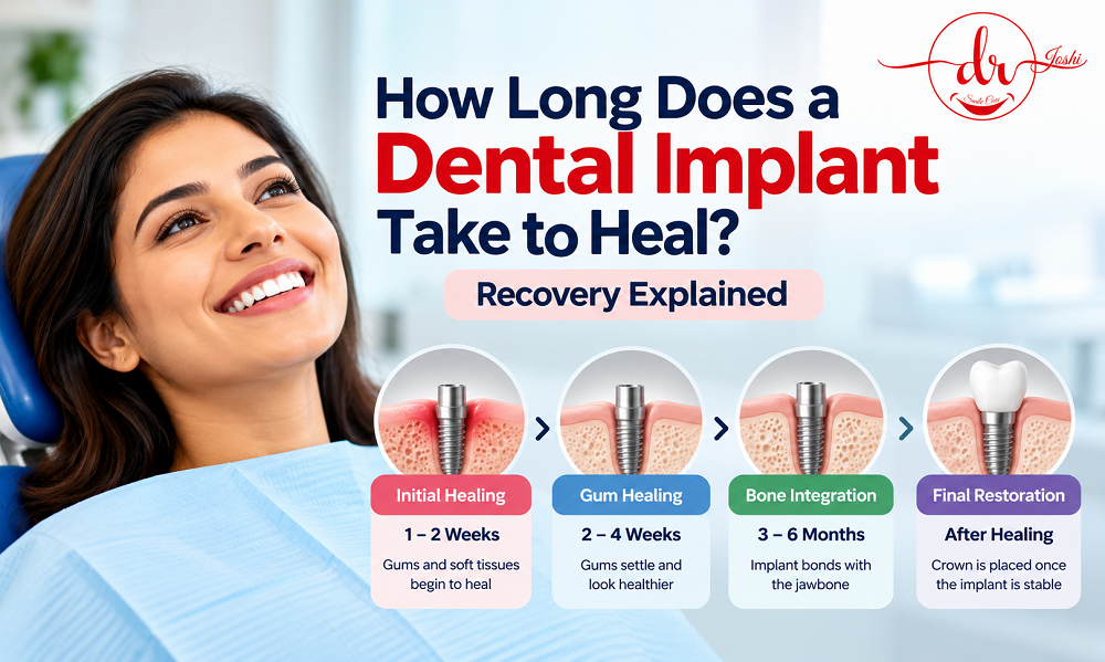 Dental Implant Healing Time – Recovery Explained